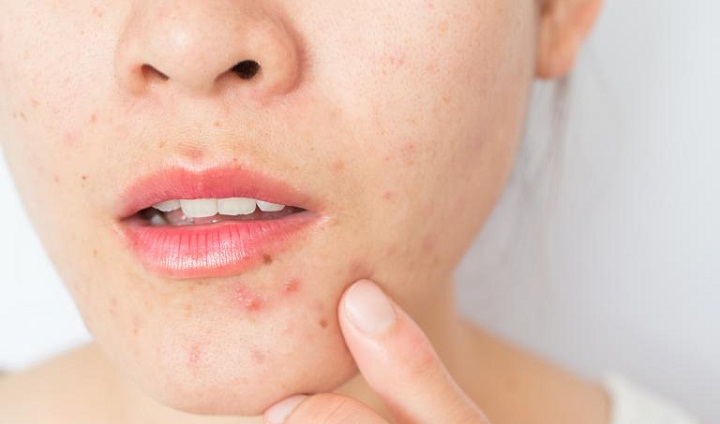 با این روش‌های خانگی جوش صورت خود را درمان کنید و پوستی صاف و شفاف داشته باشید