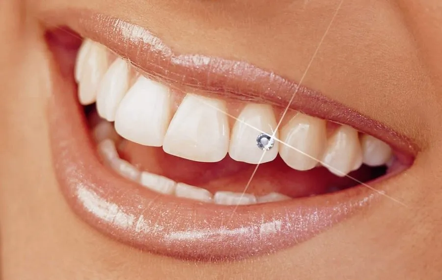 نگین دندان زیبایی و جذابیت در لبخند شما