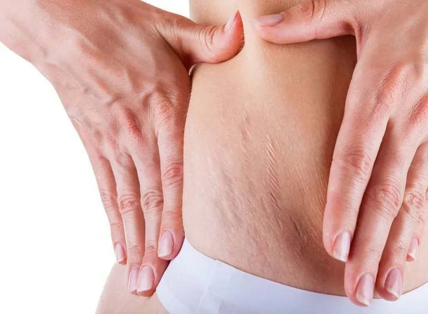 از بین بردن ترک‌های پوستی با روش‌های مدرن و موثر