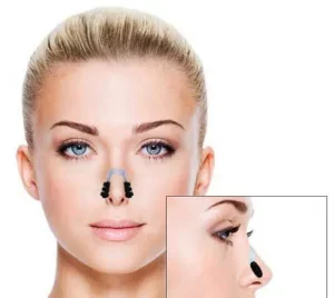 گیره کوچک کننده و حالت دهنده بینی