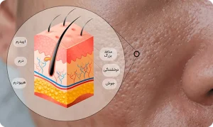 سبوم پوست چربی دوست‌داشتنی که دردسرهای خاص خود را دارد!