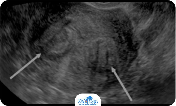 علت به وجود آمدن فیبروم رحم چیست؟ - تصویر 3