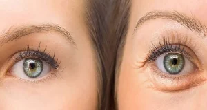 علت پف زیر چشم