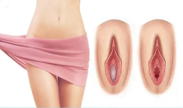 پرده بکارت یا هایمن