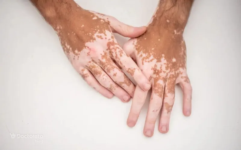 درمان قطعی لک‌های سفید پوستی