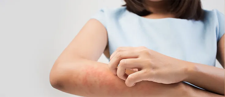 بیماری اگزما چیست و چگونه درمان می‌‌شود؟