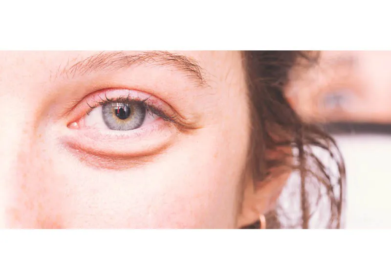 کمبود کدام ویتامین باعث پف زیر چشم میشود؟