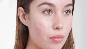 آکنه کیستیک